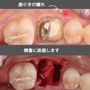 CTシミュレーション