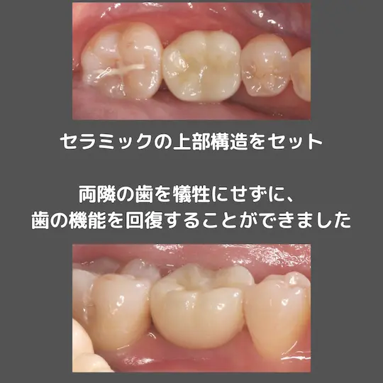 インプラント埋入完了