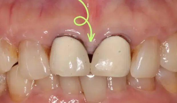 歯のブラックトライアングルとは 原因と治療法