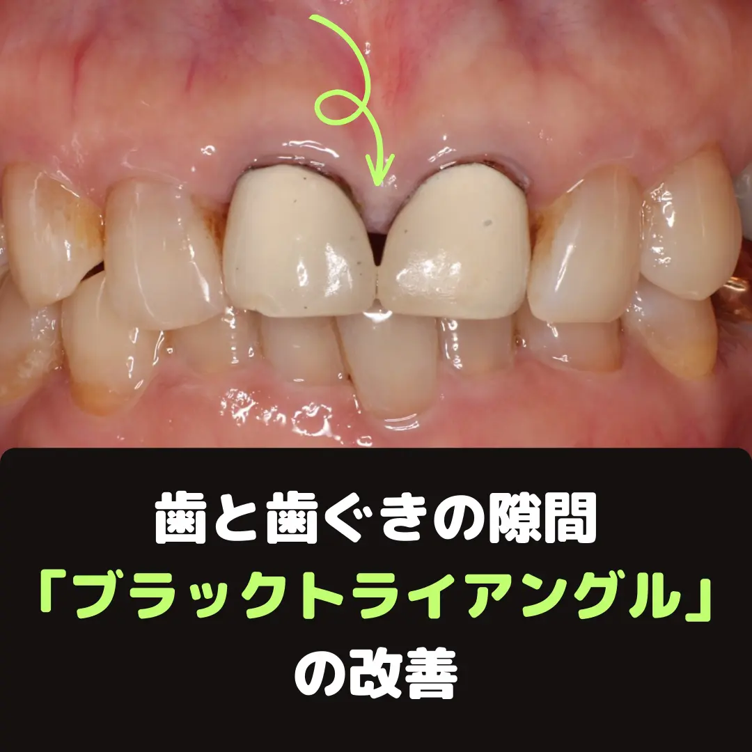 ブラックトライアングルの例