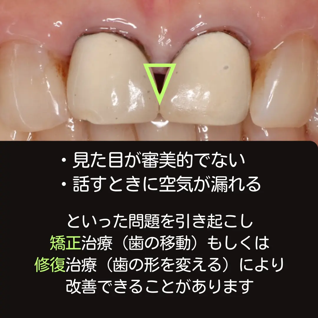 ブラックトライアングルの影響