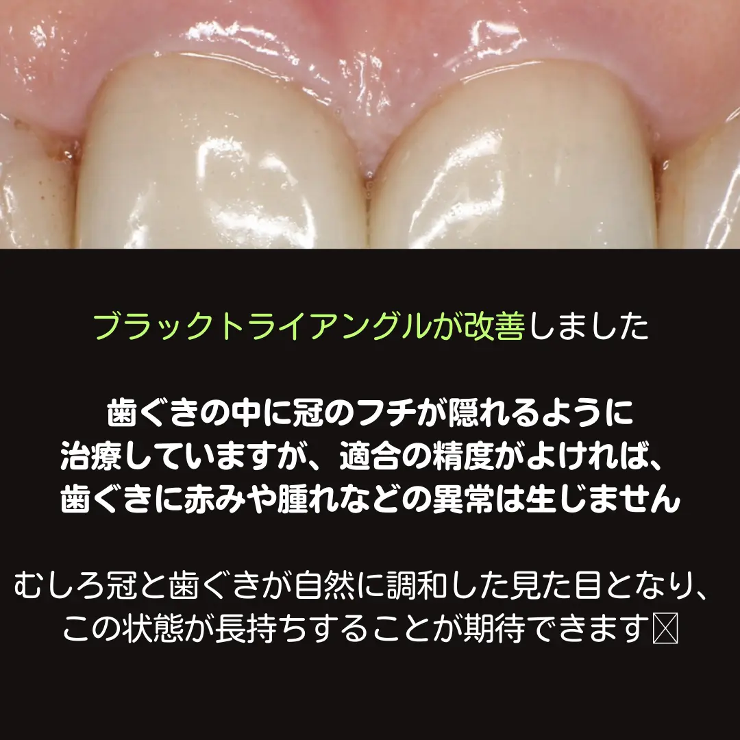 ジルコニアクラウン治療後