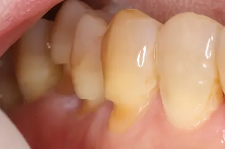 歯の付け根の欠け NCCL