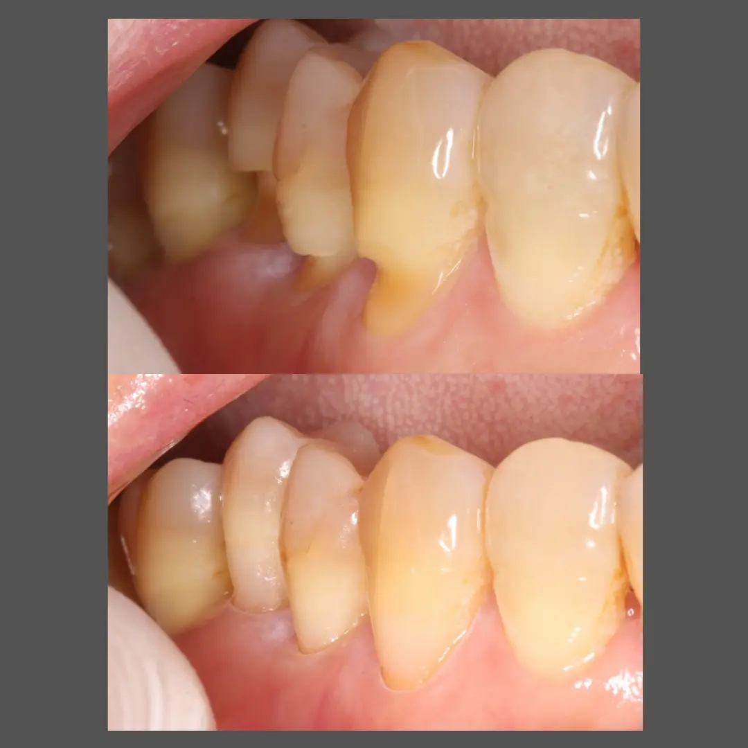 レジン充填による修復