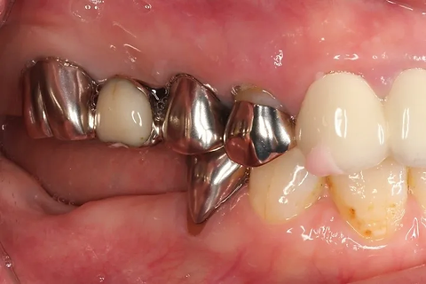 インプラント治療 術後