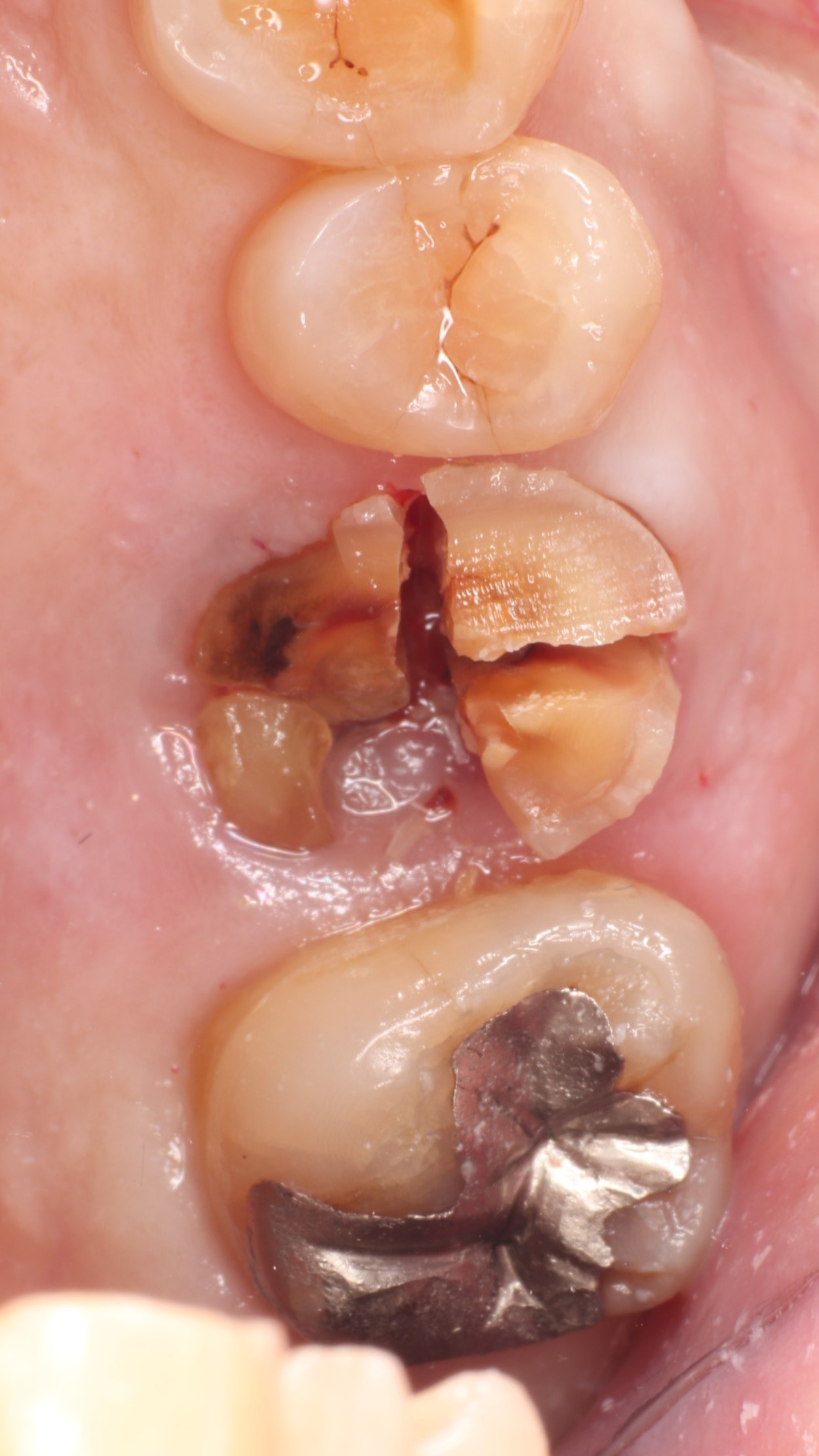 根破折した上顎大臼歯