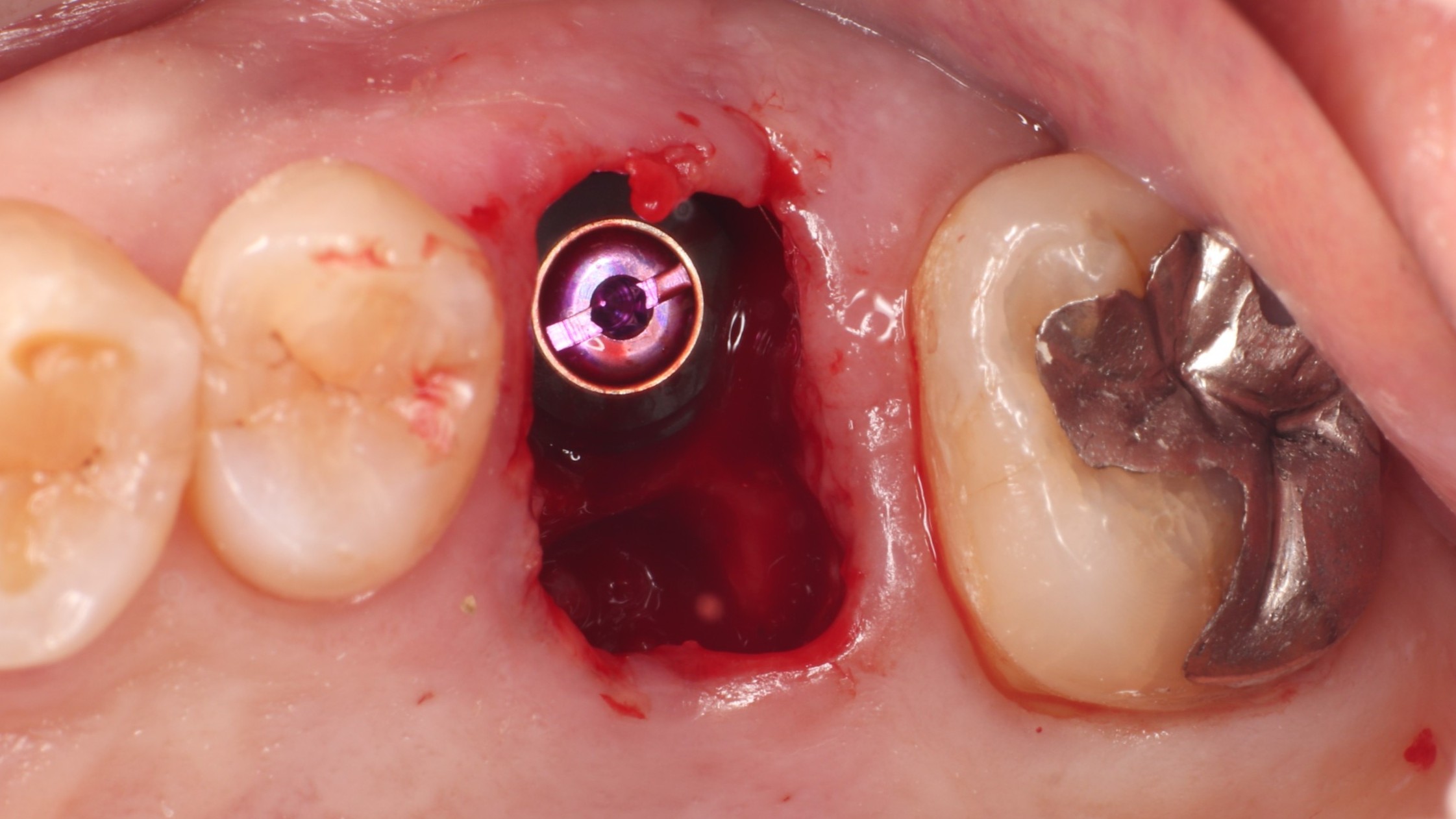 インプラント即時埋入と自家骨填入