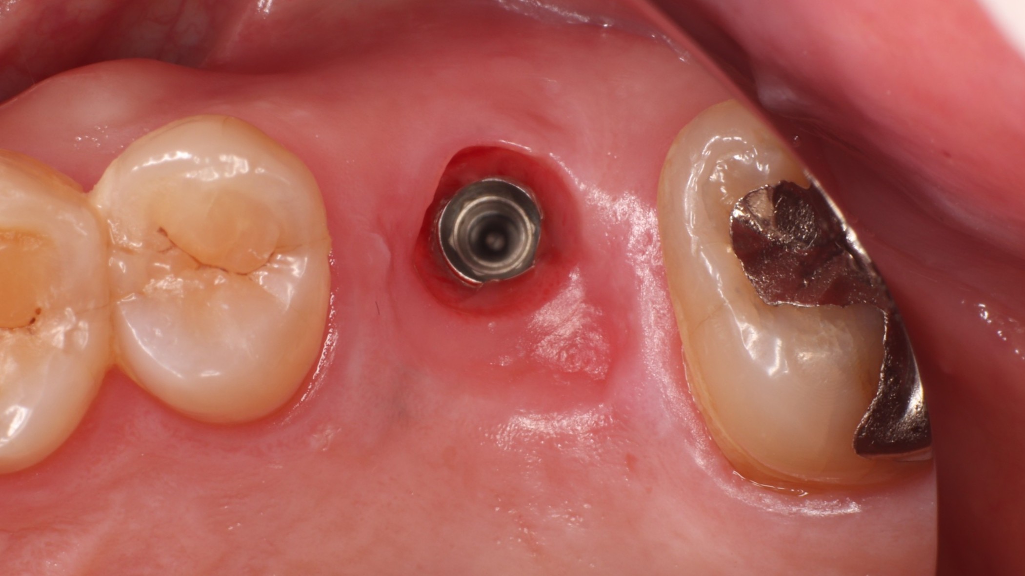 ヒーリングアバットメント装着中