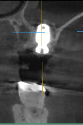 術前CTスキャン