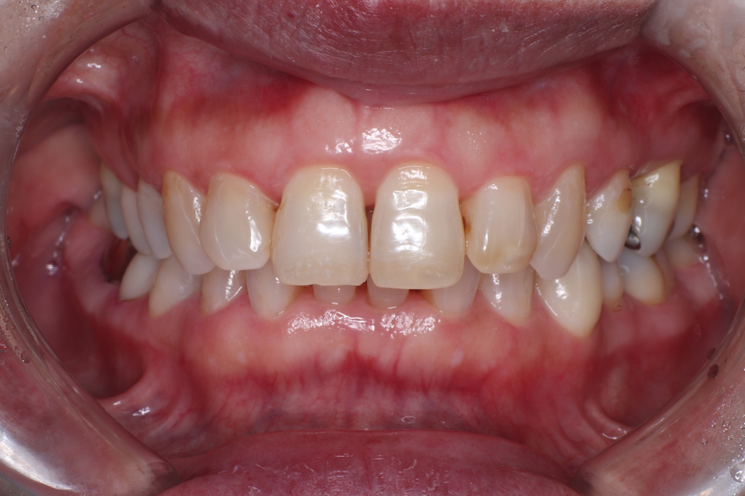 歯周病治療 術後写真