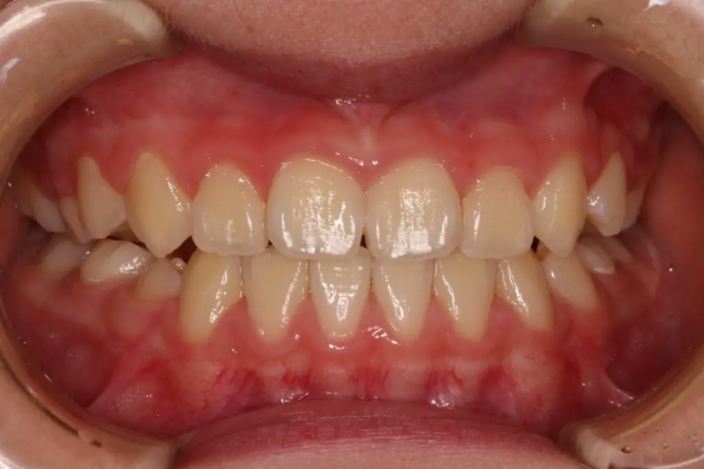 治療3年後の状態