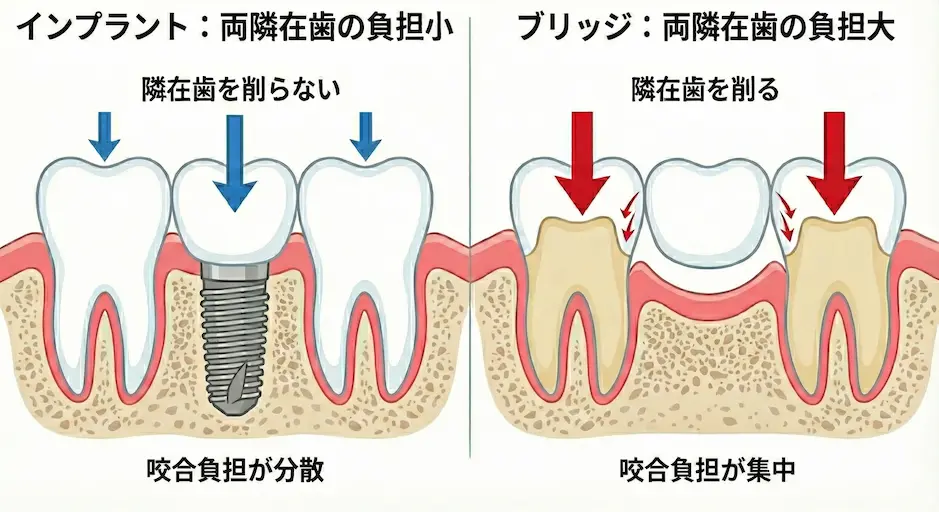 ブリッジとインプラントの負担比較イラスト